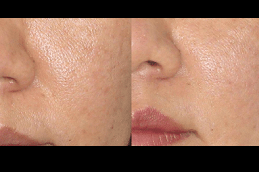 Spectra Laser Carbon Peel Dubai & Abu Dhabi