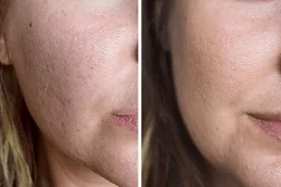 Spectra Laser Carbon Peel in Abu Dhabi