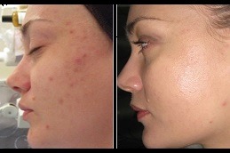 Spectra Laser Carbon Peel in Dubai