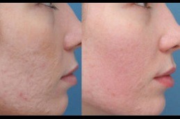 Spectra Laser Carbon Peel