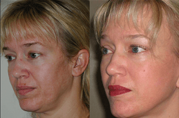 Stemcell Facelift Treatment Clinic in Abu Dhabi