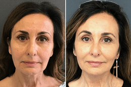 Stemcell Facelift Treatment Clinic in Dubai