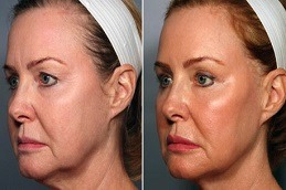Stemcell Facelift Treatment in Abu Dhabi