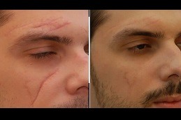 Surgical Scar Revision Abu Dhabi
