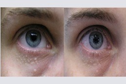 Syringoma Removal in Dubai