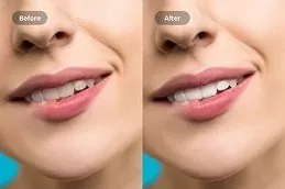 Teeth Whitening Abu Dhabi