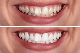 Teeth Whitening Dubai & Abu Dhabi
