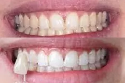 Teeth Whitening in Abu Dhabi