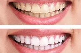 Teeth Whitening in Dubai & Abu Dhabi