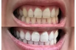 Teeth Whitening in Dubai and Abu Dhabi