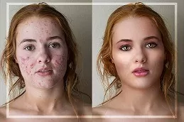 Wrinkle Smoothing Clinic in Dubai