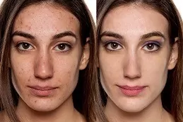 Wrinkle Smoothing in Abu Dhabi