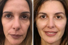 non surgical facelift in Dubai & Abu dhabi
