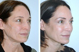 non surgical facelift in Dubai