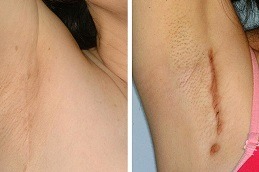 post surgical scars in Abu Dhabi