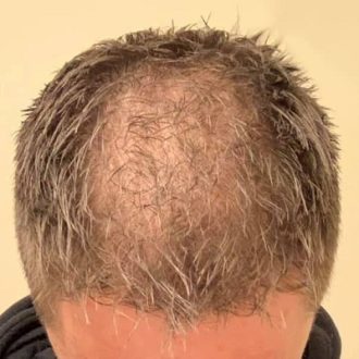 2000 & 3000 Grafts Hair Transplant Cost in Dubai