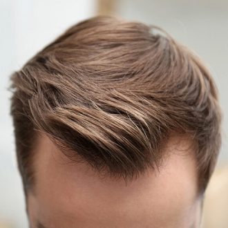 4000 & 5000 Grafts Hair Transplant Cost in Dubai