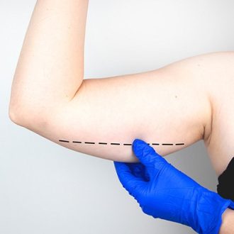 Arm Liposuction Cost in Dubai UAE
