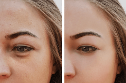 Best Clinic of Hyaluronic Acid Fillers for Under Eyes in Dubai - Copy