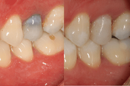 Best Clinic of Root Canal Treatment Cost in Dubai