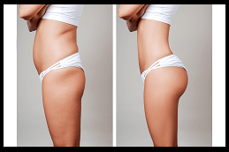 Best Clinic of Vacuum Therapy for Buttocks Dubai