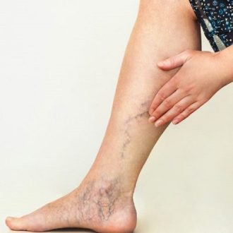 Best Doctor for Varicose Veins in Dubai & Abu Dhabi