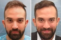 Best Hair Transplant Clinic Ras Al Khaimah