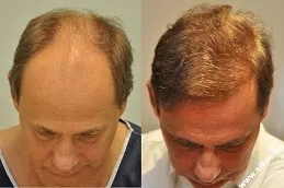 Best Hair Transplant Ras Al Khaimah UAE