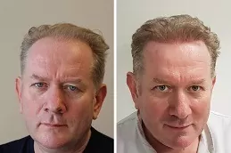 Best Hair Transplant Ras Al Khaimah