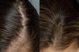 Best PRP Hair Treatment Cost Clinic in Dubai