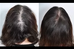 Best PRP Hair Treatment in Dubai