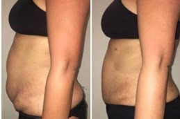 Bodytite Liposuction Dubai