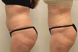 Bodytite Liposuction in Dubai