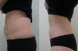 Bodytite Liposuction Dubai