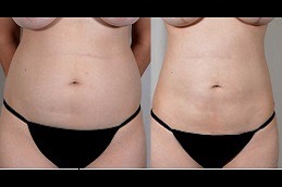 Best Bodytite Liposuction