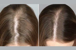 Cheapest PRP Treatment Clinic Abu Dhabi
