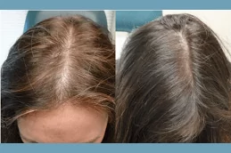 Cheapest PRP Treatment Clinic Dubai