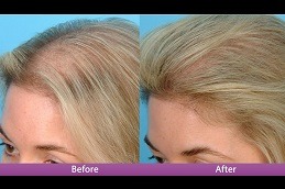 Cheapest PRP Treatment Clinic in Dubai & Abu Dhabi