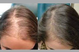 Cheapest PRP Treatment Clinic in Dubai