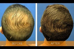 Cheapest PRP Treatment in Dubai & Abu Dhabi