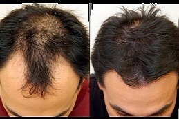 Cheapest PRP Treatment in Dubai