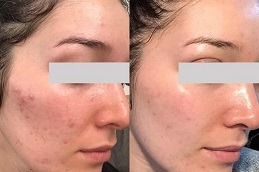 Concentrated Growth Factor Clinic in Dubai