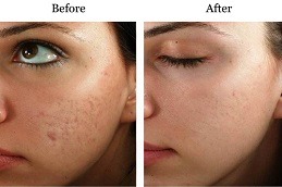 Concentrated Growth Factor Dubai