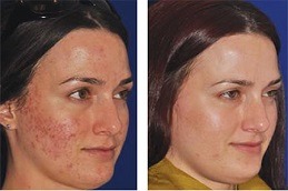 Dermapen Micro-Needling Abu Dhabi