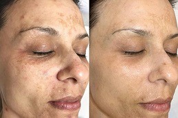 Dermapen Micro-Needling Clinic in Abu Dhabi