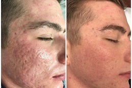 Dermapen Micro-Needling Clinic in Dubai