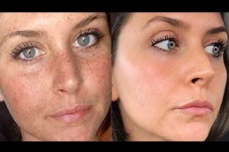 Dermapen Micro-Needling Dubai
