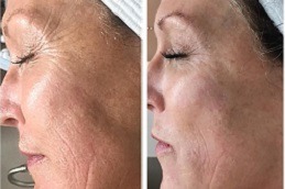 Dermapen Micro-Needling in Abu Dhabi