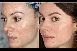 Dermapen Micro-Needling in Dubai