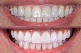 E-Max Veneers Clinic in Abu Dhabi